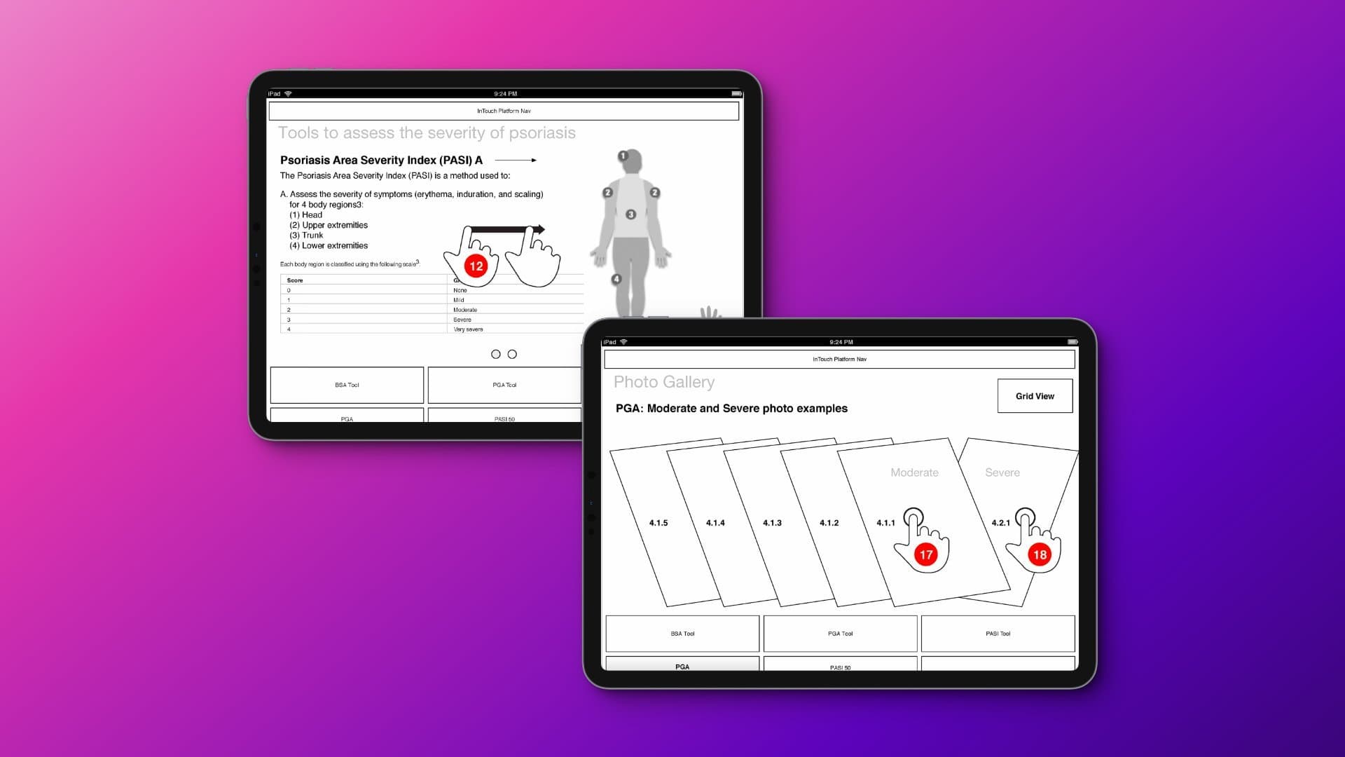 PASI/PGA psoriasis assessment tools, cross-therapeutic system extension